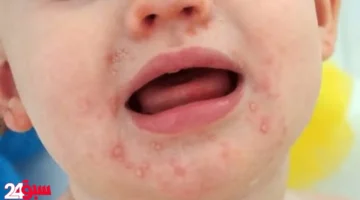 عدوى فيروس HFMD.. الصحة تحسم الجدل وتكشف حقيقة انتشاره بين الأطفال
